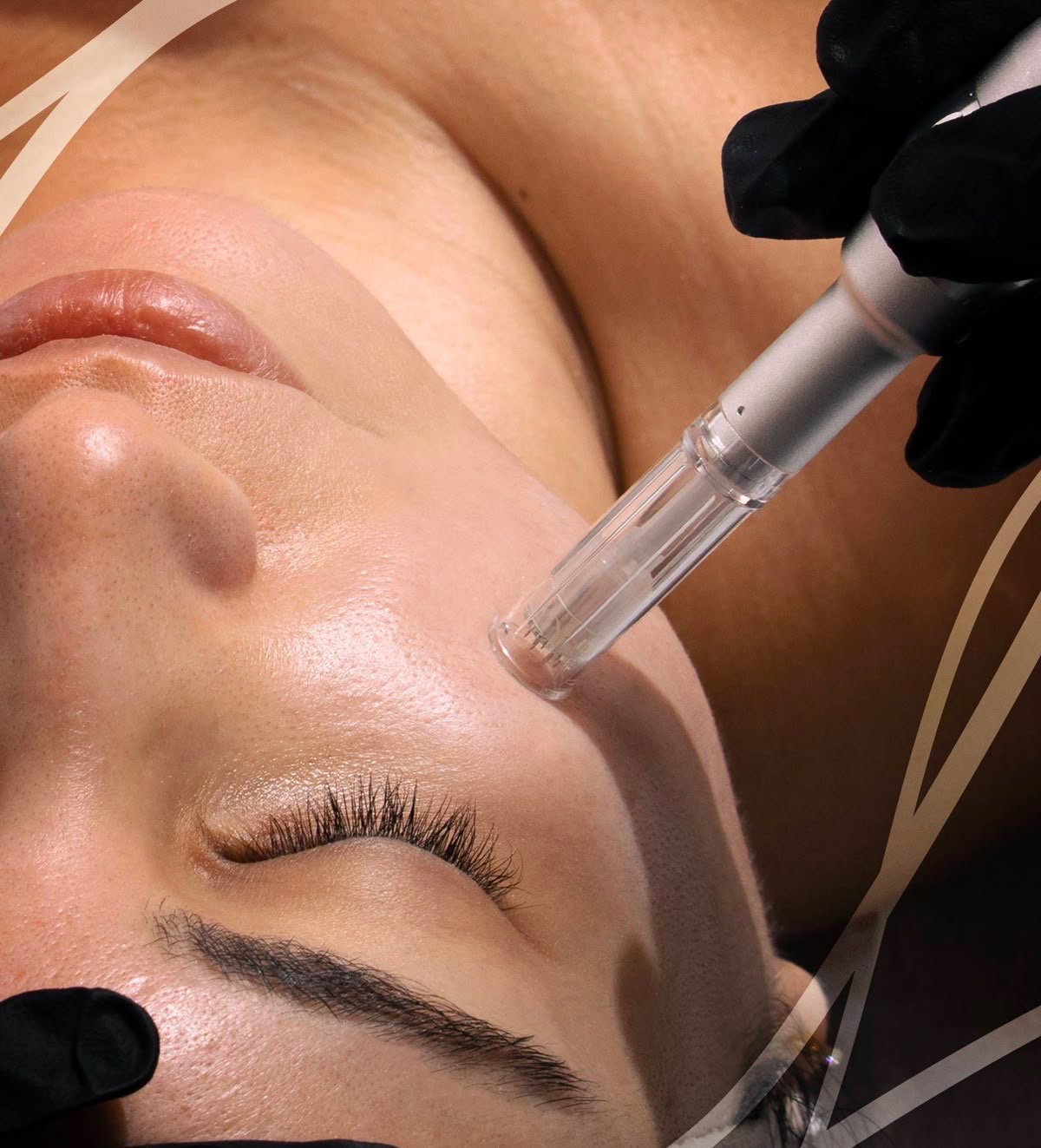 Το Dermapen είναι μια συσκευή μικροβελονισμού (microneedling) που χρησιμοποιείται στην αισθητική και την δερματολογία για την αναζωογόνηση του δέρματος, τη μείωση ουλών, ρυτίδων και δυσχρωμιών.  Πώς λειτουργεί;  Το Dermapen διαθέτει πολλές μικρές, λεπτές βελόνες που δημιουργούν μικροσκοπικές νυγμές στην επιδερμίδα, διεγείροντας τη φυσική παραγωγή κολλαγόνου και ελαστίνης. Αυτή η διαδικασία ενεργοποιεί τη διαδικασία επούλωσης του δέρματος, κάνοντάς το πιο σφριγηλό, λείο και ανανεωμένο.